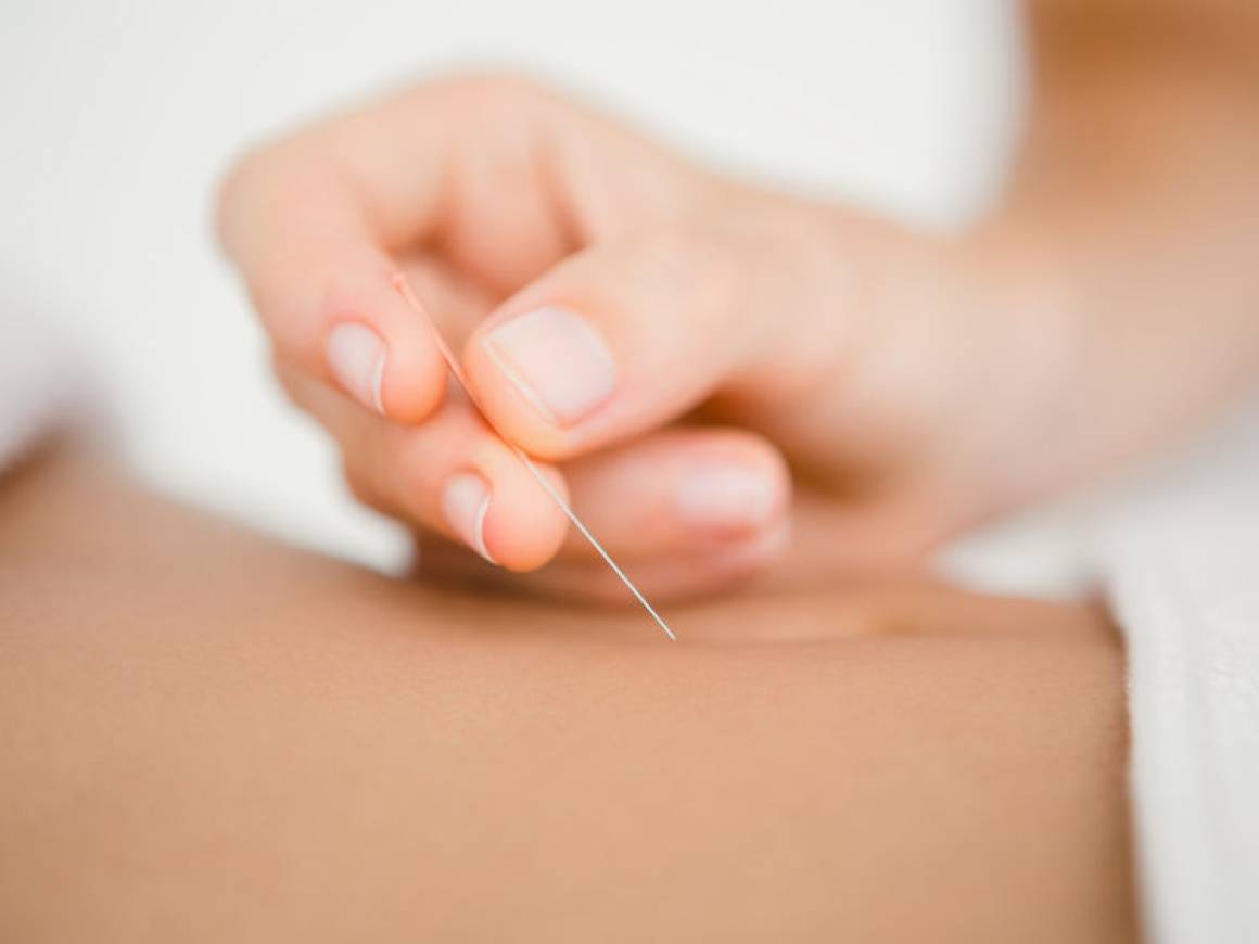 Acupuncture Therapy